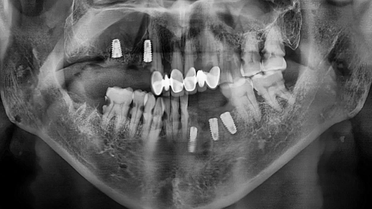 The same sinus clear after medication, before implant placement