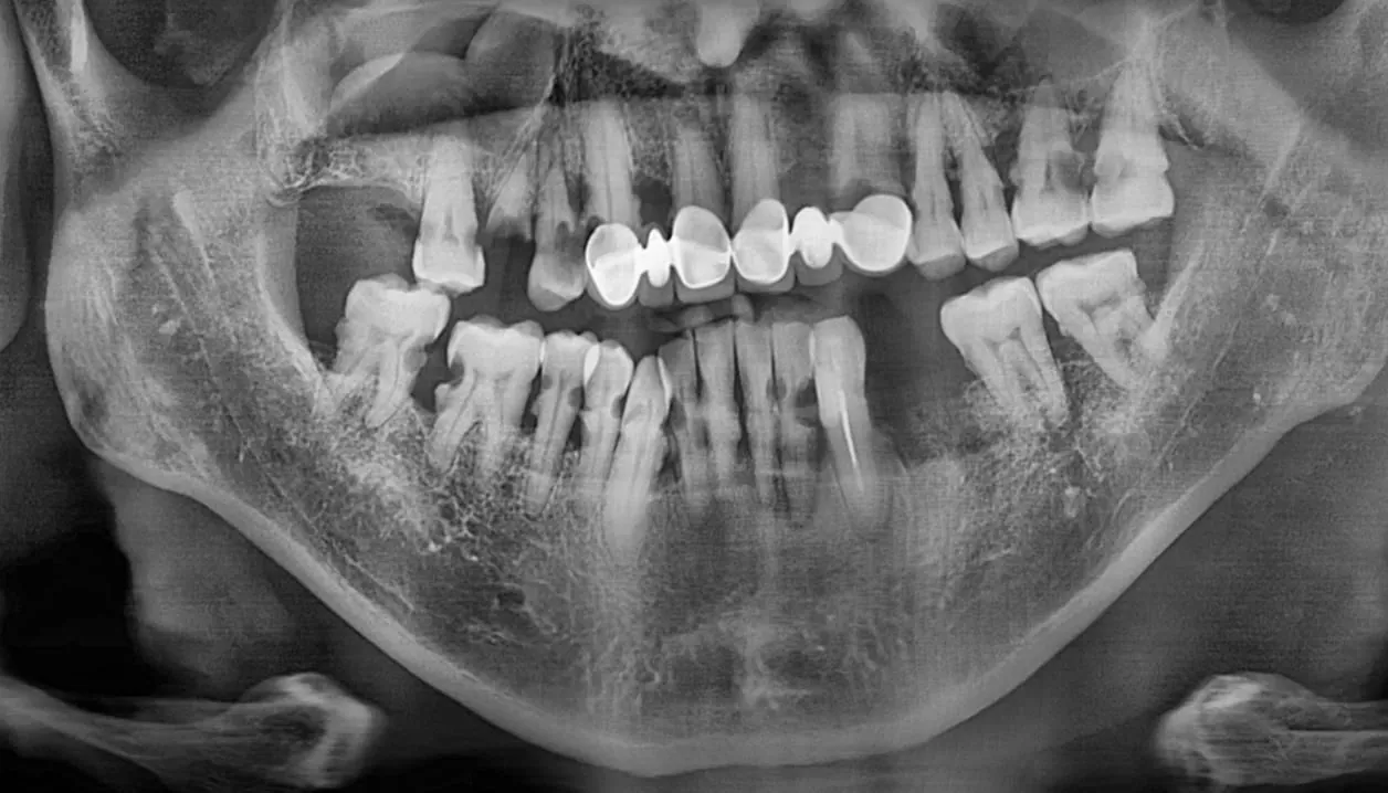 Radiograph showing marked maxillary sinusitis before treatment
