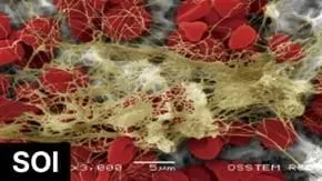 Scanning electron micrograph of an Osstem SOI surface with blood cells and fibrin