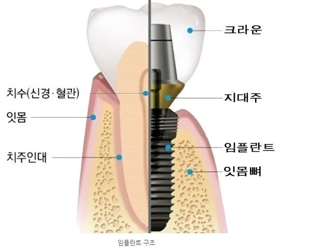 An implant in section: crown, abutment and fixture against gum, ligament and bone