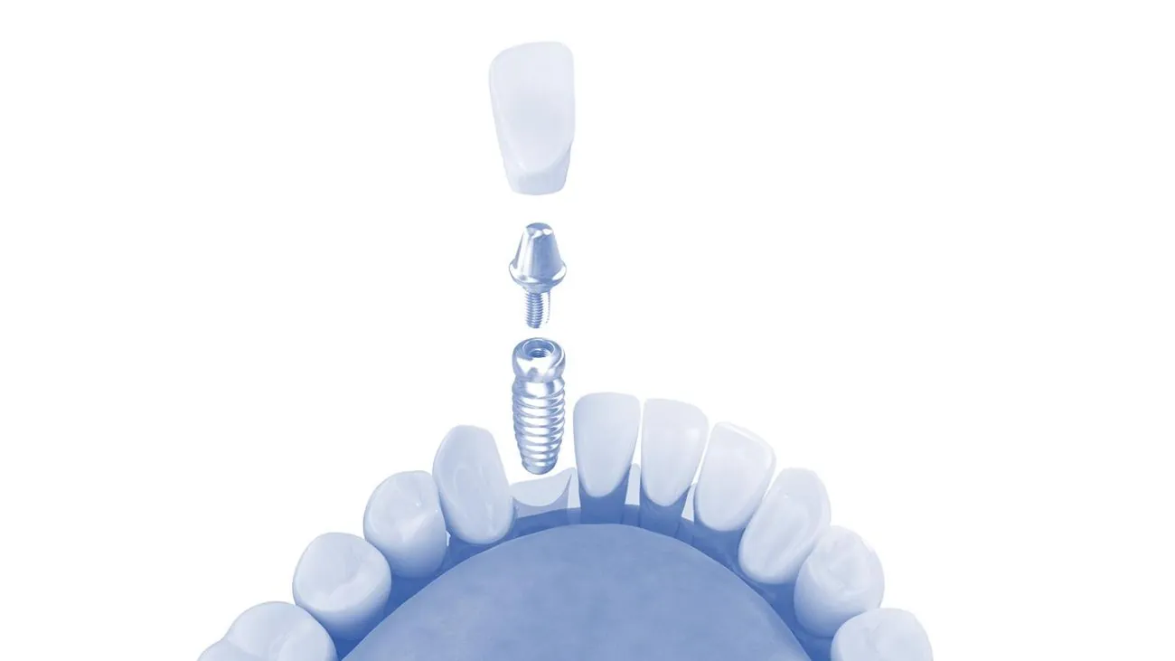 An implant crown, abutment and fixture shown separated above a dental arch