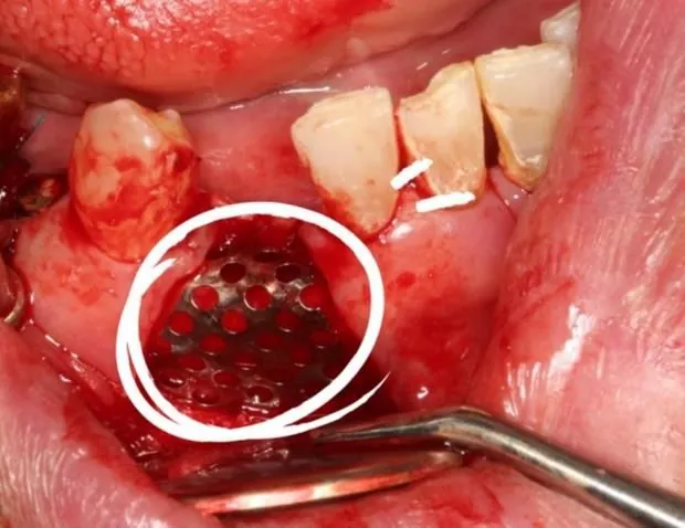 A titanium mesh being positioned over a vertical defect