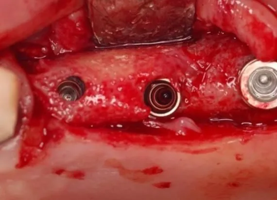 Graft material and titanium mesh in place