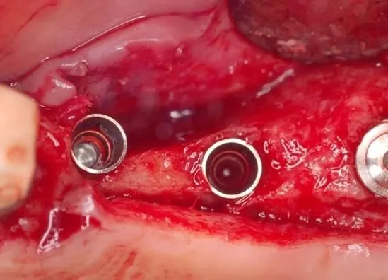 The same site after bone has formed and the mesh is removed