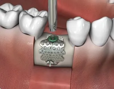 Titanium mesh shaped to hold space over a graft