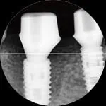 Radiograph of two placed fixtures beside a diagram of the same site